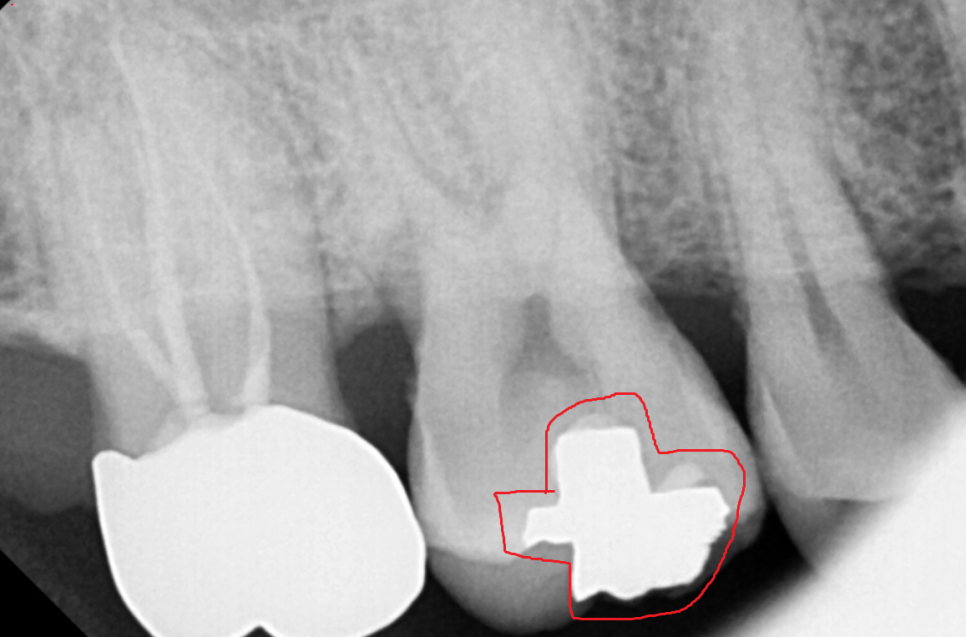 고덕동 치과 검진 시 이게 빠지면 말짱 도루묵!!! 관련 이미지 5