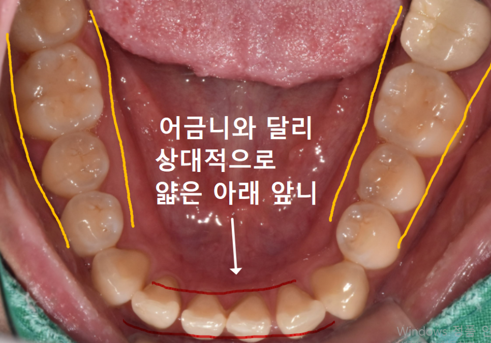 앞니 라미네이트, 치아 시림 고민 덜 수 있는 해결 방법 공개합니다. 관련 이미지 8