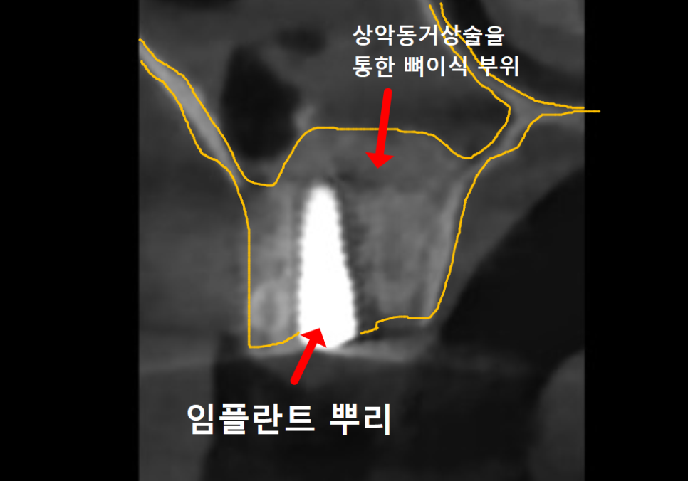 얇은 잇몸뼈 때문에 임플란트 하기 힘들다면? 저희는 관련 이미지 9