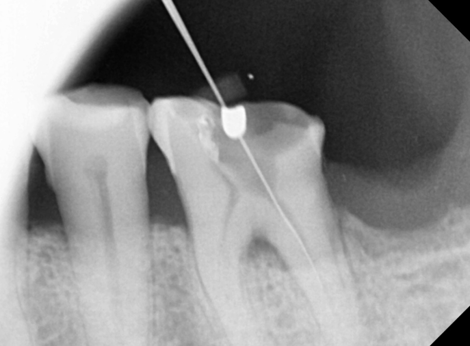 신경치료 후 통증 치아 뿌리 금으로 발치 후 강일역 임플란트 관련 이미지 3