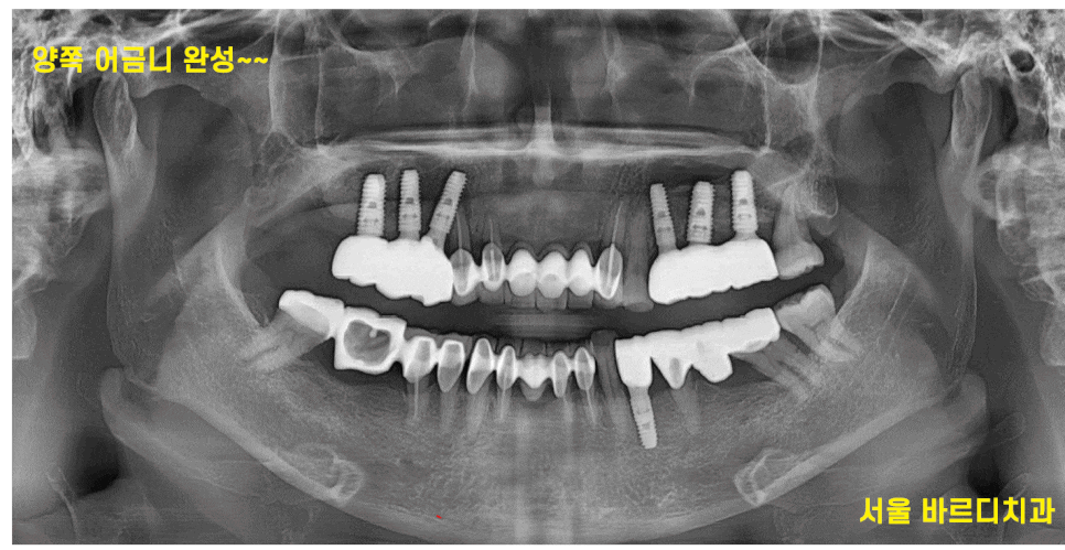 고덕동 치과 뼈이식 동반 양쪽 어금니 임플란트 동시 진행 관련 이미지 1