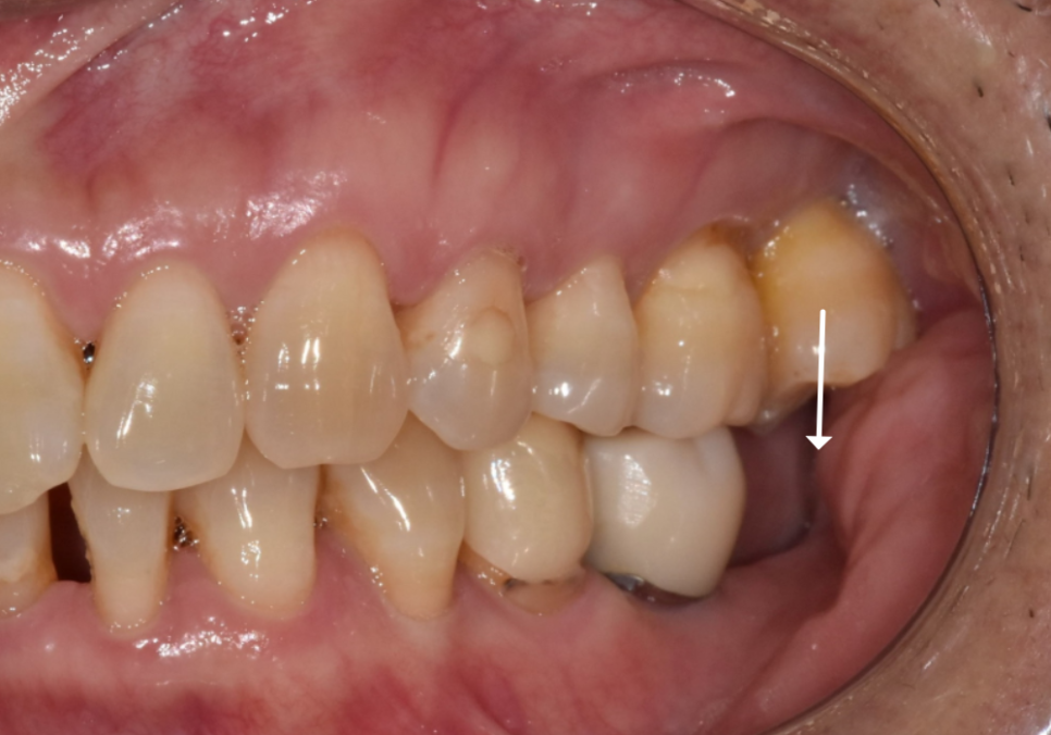 발치 후 빈 공간, 이 빼고 오래 냅두면 이렇게 됩니다. 관련 이미지 3