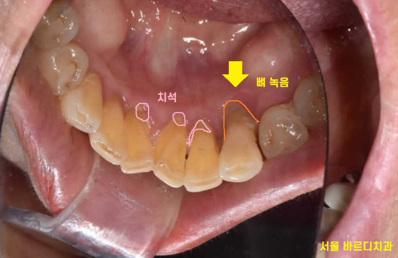 명일동 치과 심미적인 앞니는 하루만에 끝내는 빠른 임플란트로 하세요!! 관련 이미지 3
