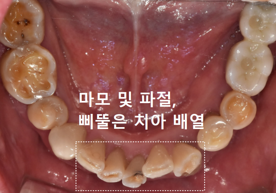 Gangdong-gu Dental Impressions: Are You Still Biting Down for 5 Minutes? We’ll Make It Comfortable with an Intraoral Scanner! image 10