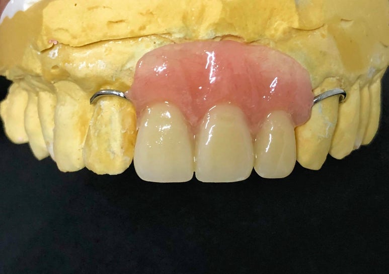 앞니 브릿지 탈락, 씌워둔 게 빠졌어요. 다시 붙일 수 있을까요? 관련 이미지 15