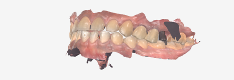 어금니 구멍, 충치 솔직하게 말씀드립니다. 치과 공포증으로 미루신 분들 필독 관련 이미지 14