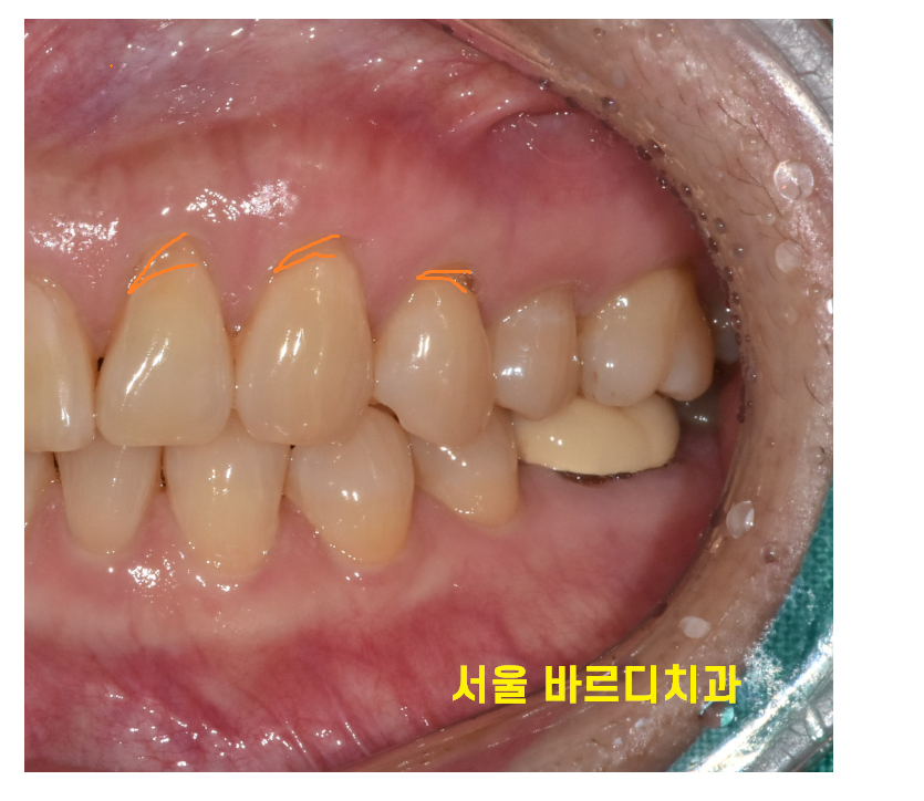 앞니 레진 재치료 변색 부위 연마하면 처음 느낌 그대로 관련 이미지 4