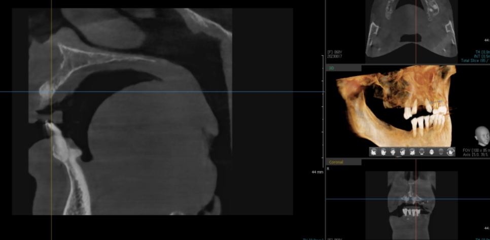 암사동 치과 전악 임플란트 하루만에 끝냈습니다. 관련 이미지 5