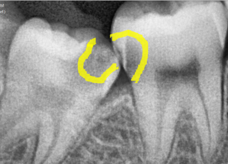 상일동 사랑니 매복 방치하다 옆 치아까지 망가진 실제 사례 관련 이미지 5