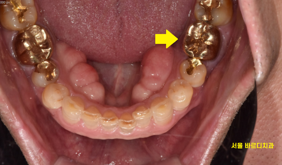 고덕역 치과 치아뿌리 파절 부러짐 있을 때 임플란트로 대체해야죠 관련 이미지 6