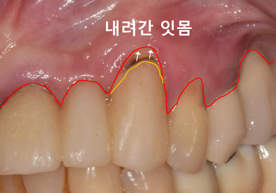 음식물 끼임, 거뭇한 무언가 보인다면? 이미 늦었을 수 있습니다. 관련 이미지 14