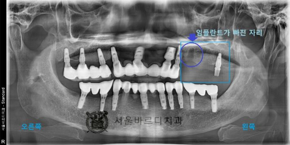 상일동역치과 서울바르디치과 무절개 네비게이션 임플란트 치료증례 #5 관련 이미지 7
