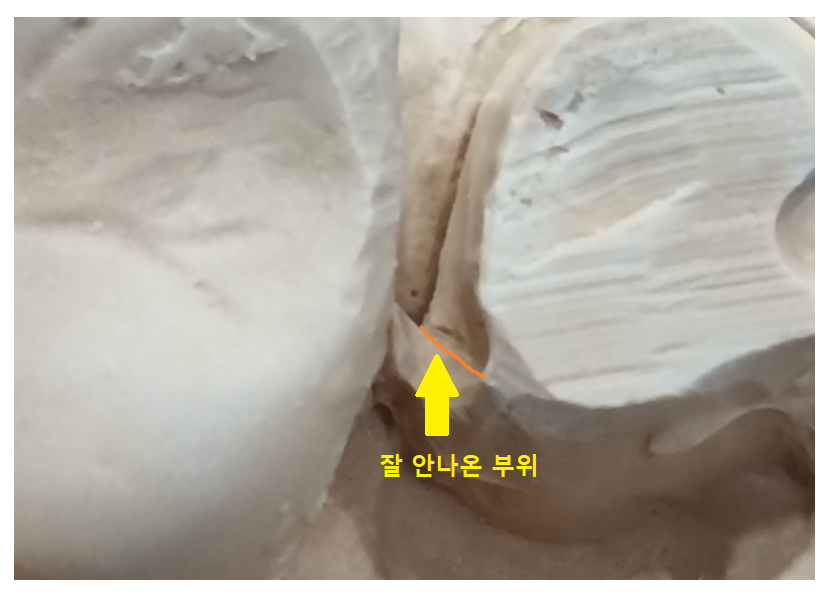 상일동역 임플란트 구강스캐너로 디지털 진료 선두하는 대표 치과입니다! 관련 이미지 5