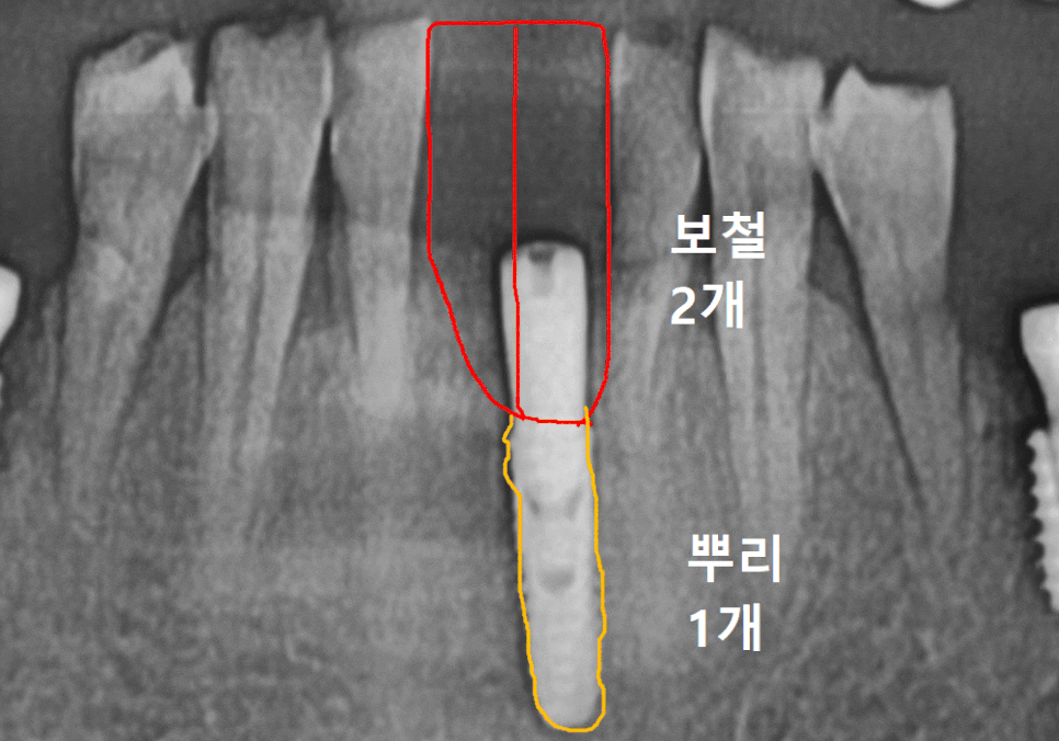 강동구 임플란트 가격 줄이는 방법 2개 발치했는데, 1개만 심어도 된다구요? 관련 이미지 1