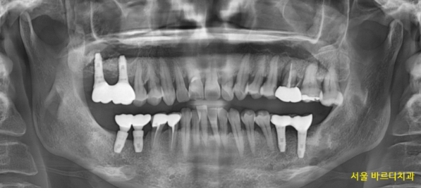 미사역 임플란트 상악동염으로 치아를 발치한 사연 관련 이미지 3