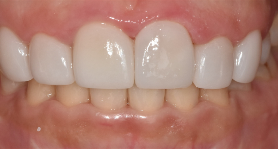 라미네이트 깨짐 원인 TOP 3, <대표원장>이 직접 알려드립니다 관련 이미지 6