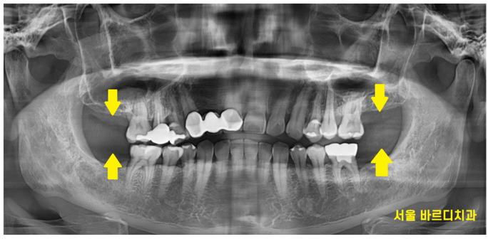 명일동 치과 임플란트 위아래 같이 한꺼번에 할 수 있나요?? 관련 이미지 2