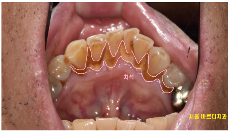 강동구 스케일링 치아 삭제 한다고 오해하지 마세요! 관련 이미지 1