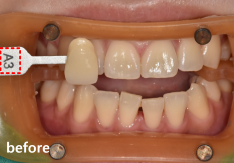 명일동 치과, 미백하면 연예인 치아처럼 새하얘진다는 말, 저는 못하겠습니다. 관련 이미지 9