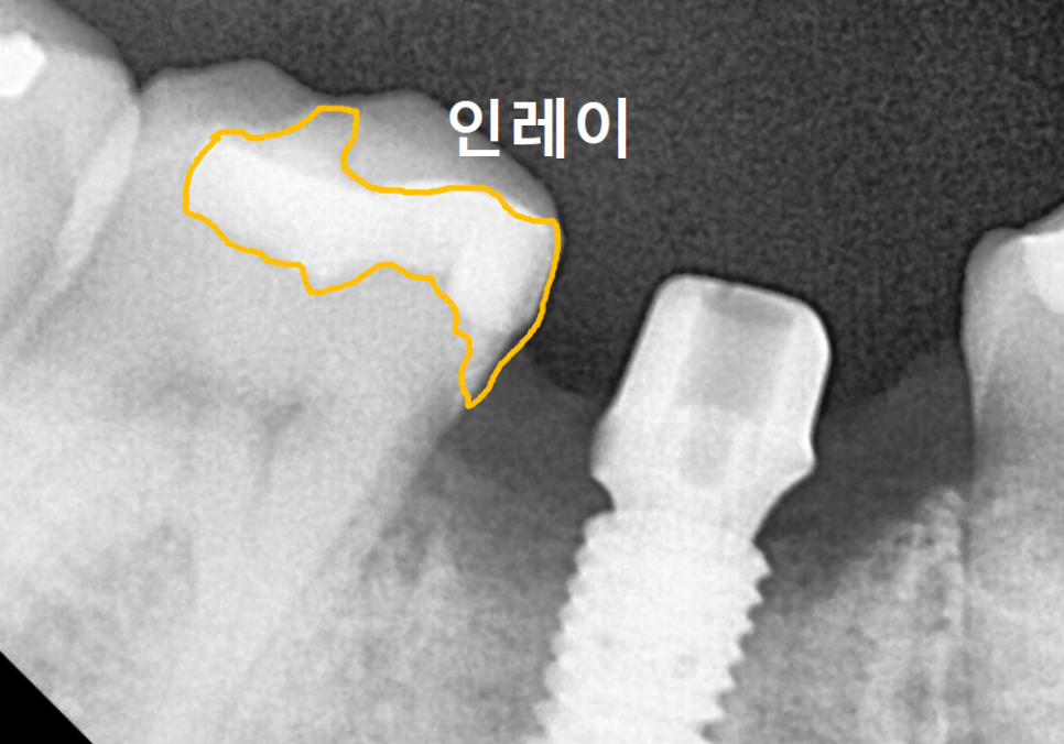 고덕동 어금니 사이 충치, 양치질 누구보다 열심히 하는데 왜 자꾸 생길까요? 관련 이미지 15