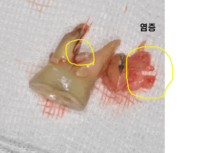고덕동 임플란트 골이식 필수일까? 궁금증 여기 모두 있어요 관련 이미지 1