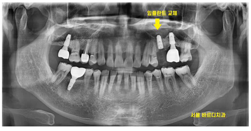 길동 치과 임플란트 보철 흔들림 교체 해야할 경우 관련 이미지 8
