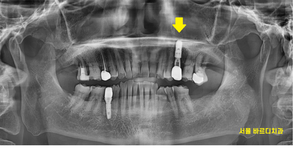 미사 임플란트 금니 빠짐 보철물 빠졌을 때 대처법 알려드려요 관련 이미지 7