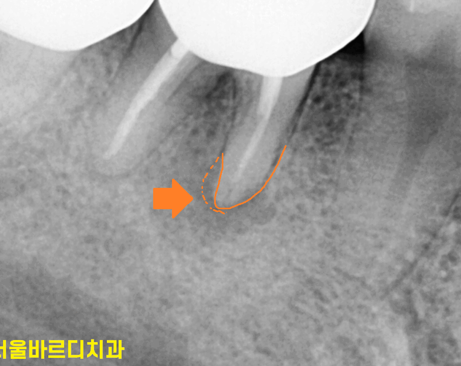 잇몸 물집 강일역 치과에서 원인 알아보고 임플란트로 치료했습니다. 관련 이미지 1