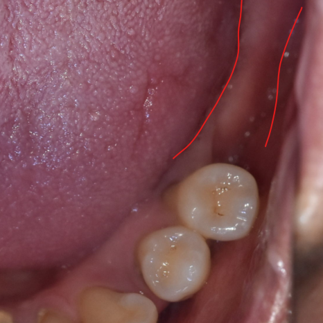 Gangdong-gu Dental Clinic: Are There Cases Where Implants Are Impossible? image 2