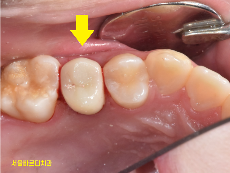강일동 치과 추석 명절 딱딱한 음식은 절대 피하세요 치아 골절 생깁니다. 관련 이미지 6