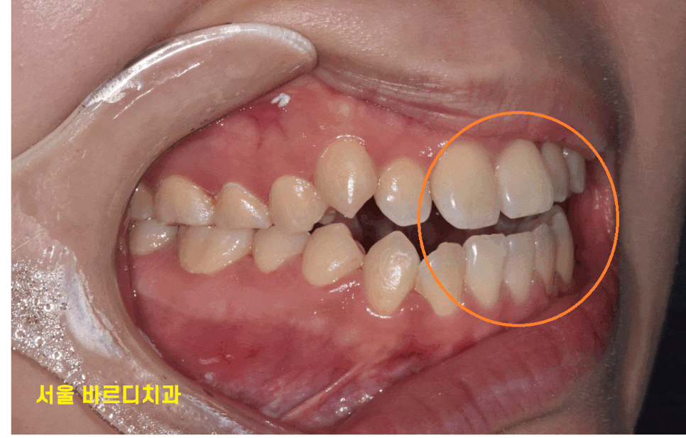 길동 치아교정 통증 겪어보지 않았기에 어느정도일까? 관련 이미지 1