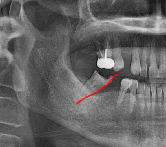 고덕동 치과 발치 후 방치하면 치아 쓰러짐 발생해요 관련 이미지 1