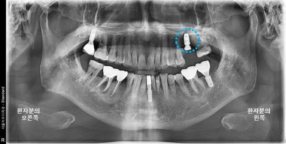 서울바르디치과 상하악 대구치 네비게이션 임플란트 치료증례 #4 관련 이미지 7