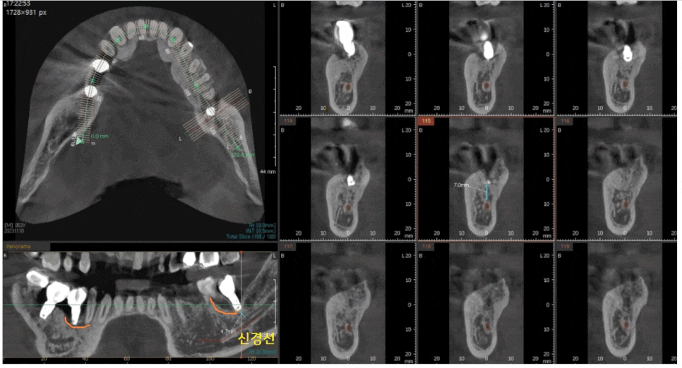 고덕동 치과 임플란트 뼈이식 꼭 해야하는건가요? 관련 이미지 1