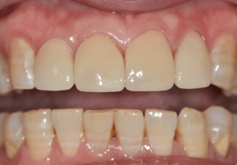 50대 라미네이트, 앞니 벌어짐과 변색 고민 이렇게 해결했습니다. 관련 이미지 8