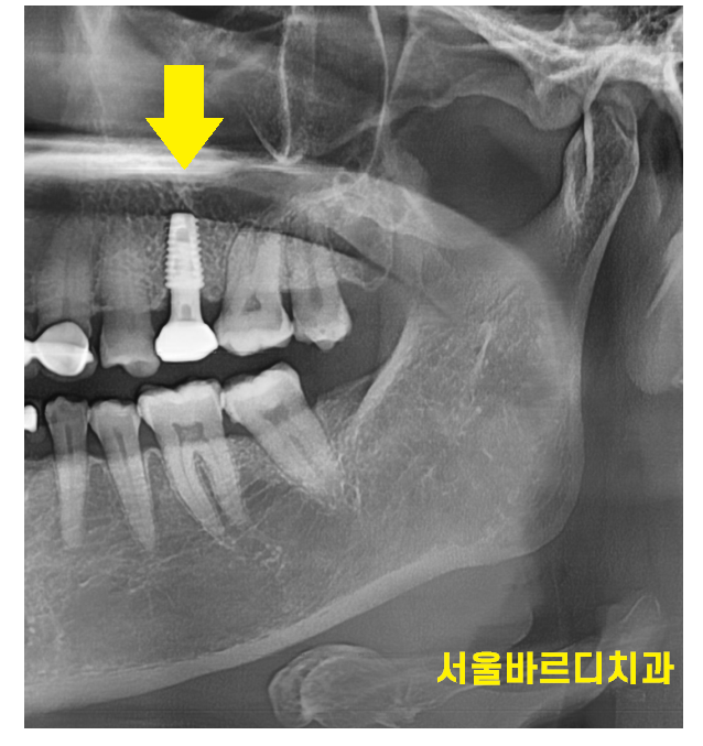길동 치과 임플란트 수술 대안은 없을까요???? 관련 이미지 4