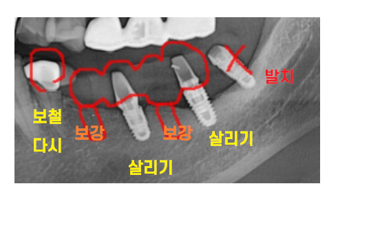 고덕동치과 이가 다 부서졌을 때 임플란트 치료했습니다. 관련 이미지 7