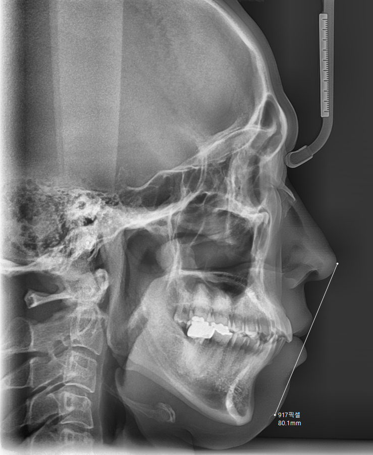 고덕역 교정치과 40대인데 치아 교정 가능한가요? 관련 이미지 5