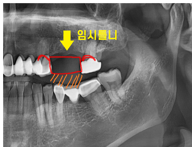 풍산동 임플란트 이 뽑고 임시틀니는 꼭 해야하나요? 플리퍼란? 관련 이미지 4