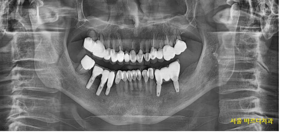 명일동 치과 뿌리 염증으로 입냄새가 나요 해결책은? 관련 이미지 2