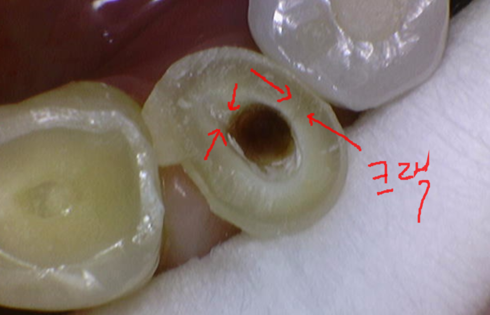금간 치아 통증 심할 때 발치와 임플란트가 필요한 이유 관련 이미지 6