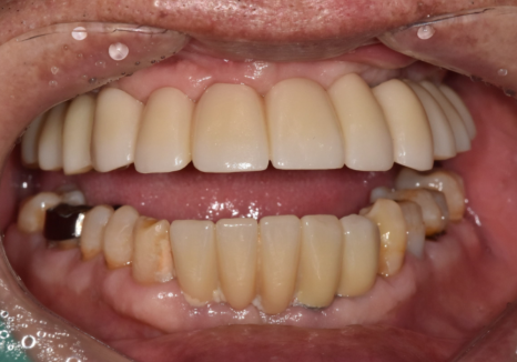 뼈가 없어서 안 된다구요? 70대 당뇨 무치악 환자분의 전체 임플란트 사례 관련 이미지 17