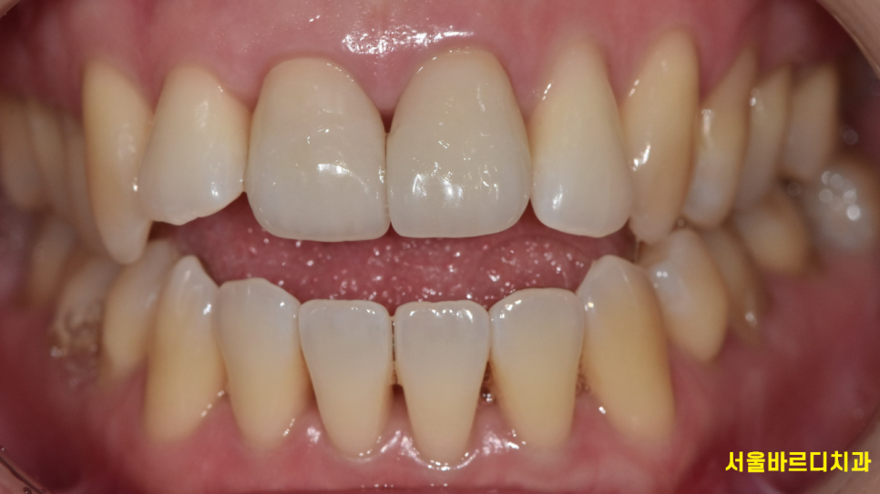 치아교정 치아 뿌리 짧아짐 치근 흡수 걱정이에요. 관련 이미지 4