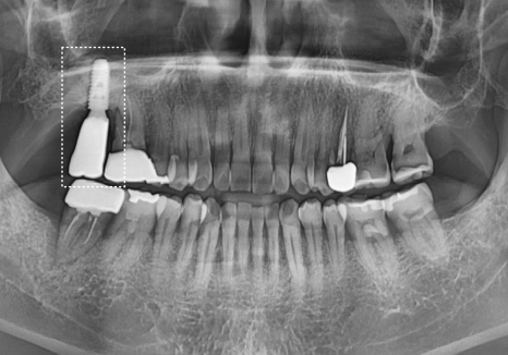 강동구 잇몸 퇴축으로 뿌리 드러난 치아, 이대로 둬도 괜찮을까? 관련 이미지 17