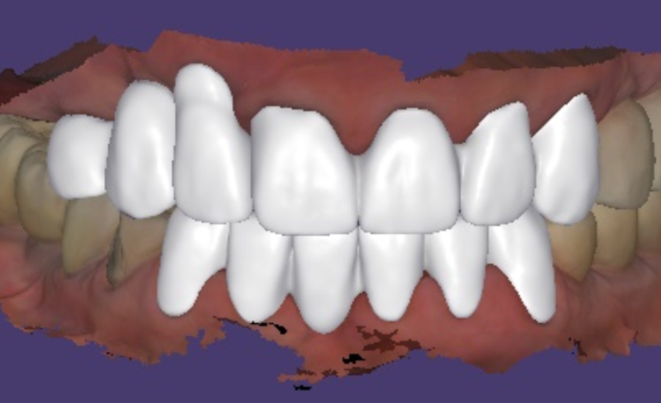 앞니 고름, 잇몸약을 먹어도 왜 염증이 가라앉지 않을까요? 관련 이미지 14