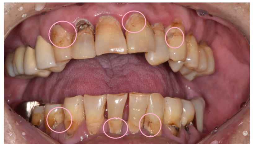 강동구 임플란트 수술 전 확인하면 좋을 3가지 관련 이미지 6