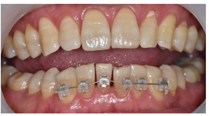 고덕동 치아교정 치아 이동 속도가 느려요 원인은? 관련 이미지 3
