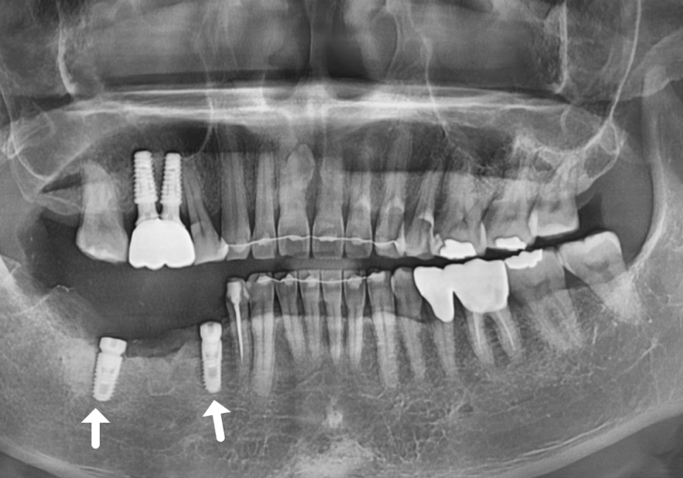 오래된 임플란트, 흔들림과 통증, 어떻게 하면 더 건강하게 쓸 수 있을까? 관련 이미지 12