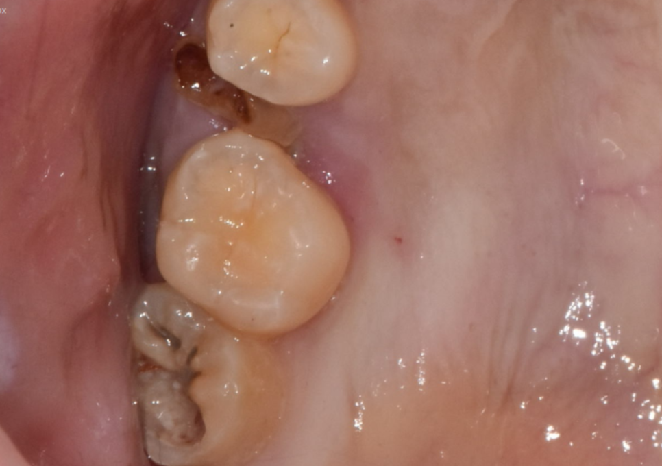 Myeongil-dong Implant Treatment in Your 20s: The Reason It Ended Up Requiring Bone Grafting After Thinking, “I’m Young, So It’ll Be Fine” image 1