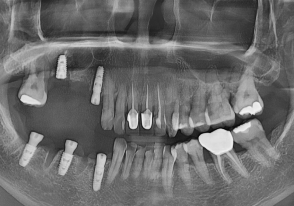 고덕동 스케일링 미루다 앞니 어금니 다 뽑고 임플란트 했습니다. 관련 이미지 18